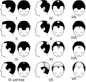Partial_Norwood_scale_for_male_pattern_baldness